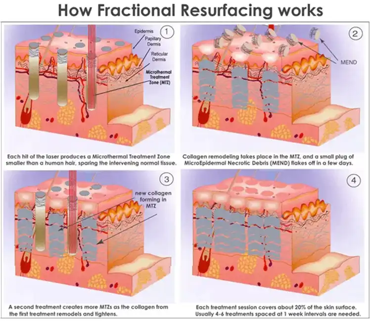 1689855554557758.webp fractional co2 laser detail 2.webp