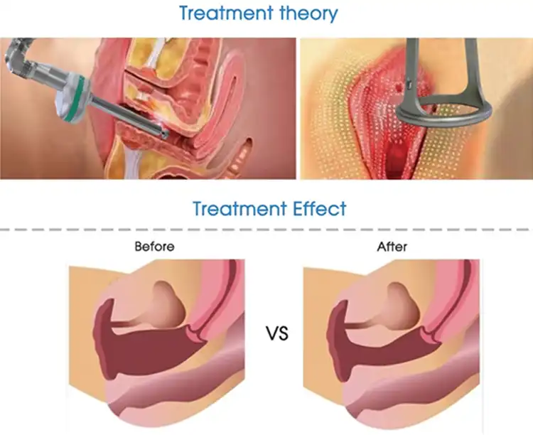1689855780664063.webp fractional co2 laser detail 3.webp