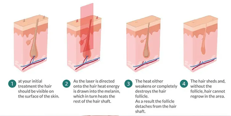 1690853085180536.webp 808nm diode laser hair removal principle .webp
