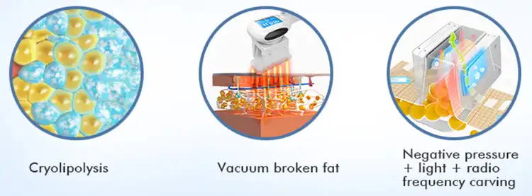 cryo vacuum RF slimming principle.webp